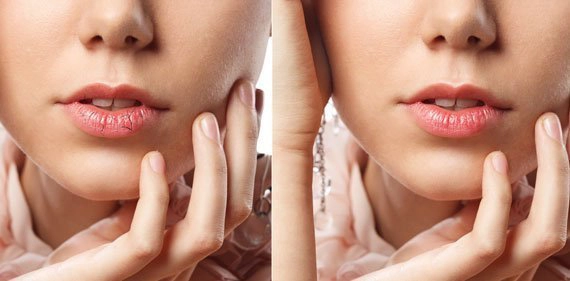 how to heal dry and chapped lips